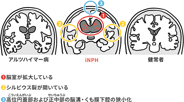 アルツハイマー病、iNPH、健常者の脳の比較画像 1.脳室が拡大している 2.シルビウス裂が開いている 3.高位円蓋部および正中部の脳溝・くも膜下腔の狭小化