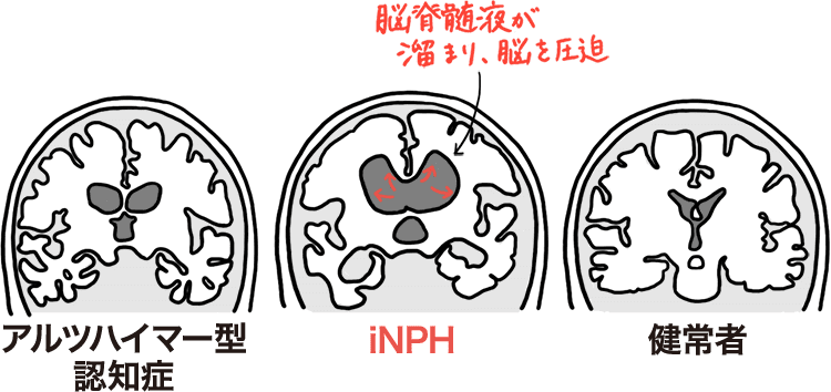 脳脊髄液が溜まり、脳を圧迫